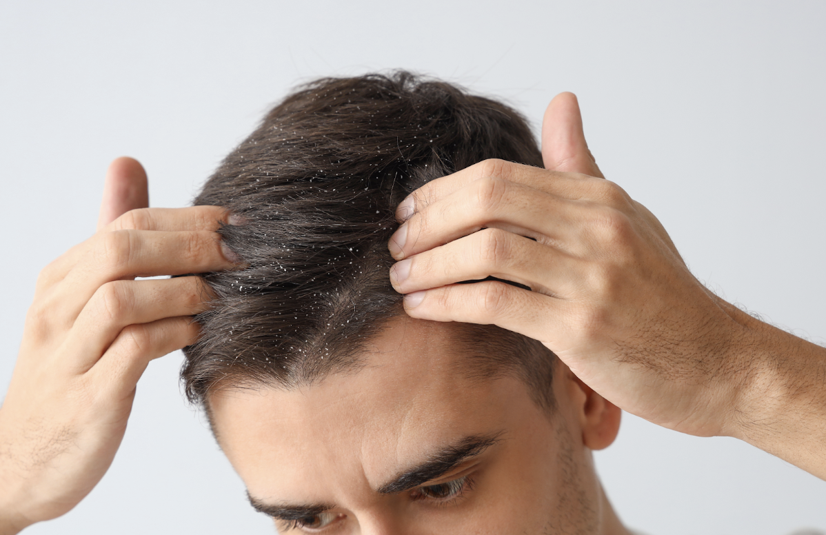 頭皮のフケに悩む男性・脂漏性皮膚炎の症状