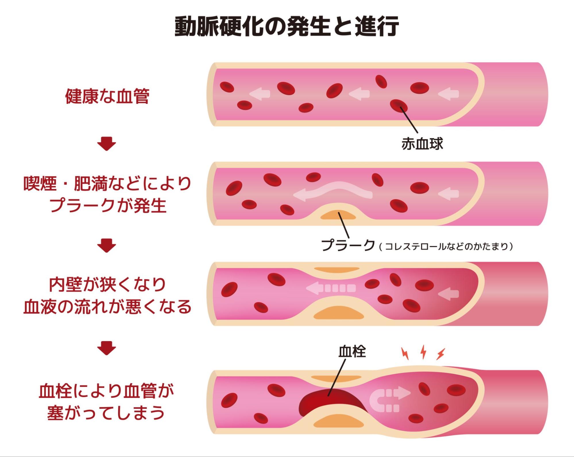 動脈硬化の発生と進行の仕組みを示す図